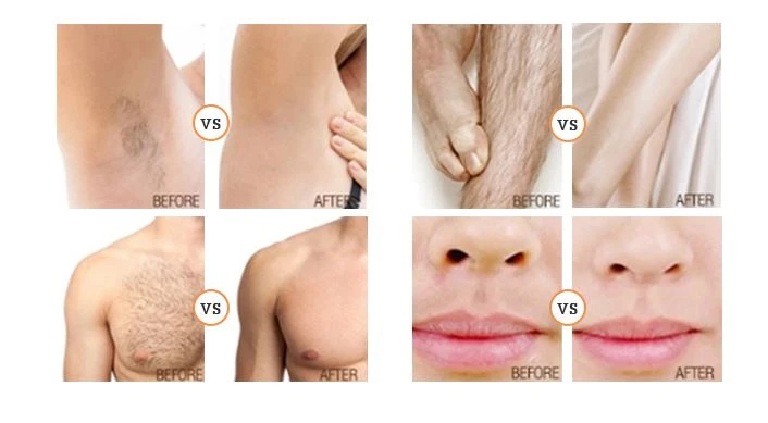 Alma Soprano Ice Titanium Hair Removal Machine