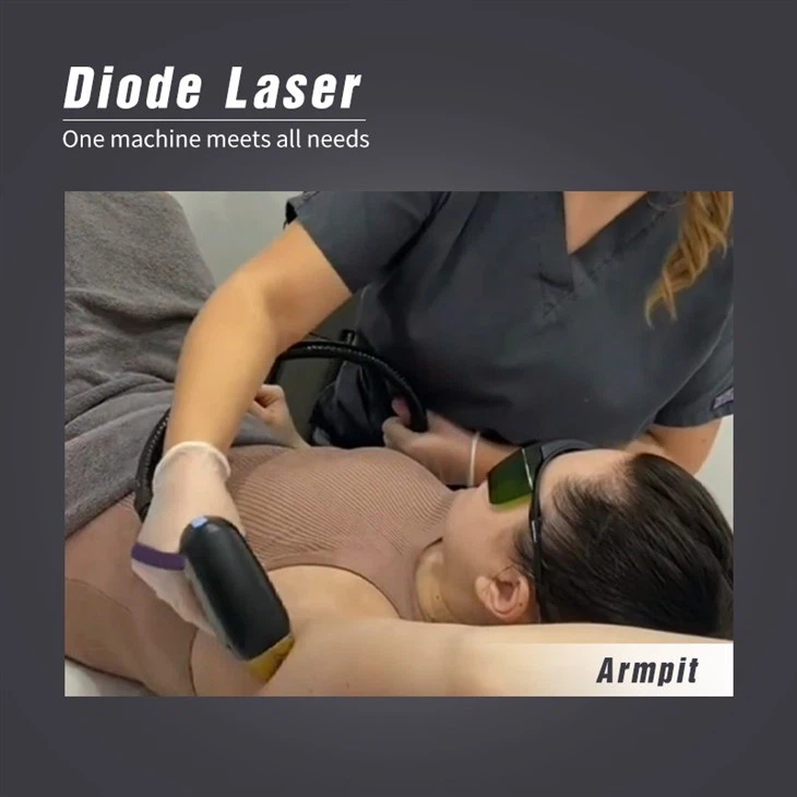 Hot Selling Laser Hair Removal Machine