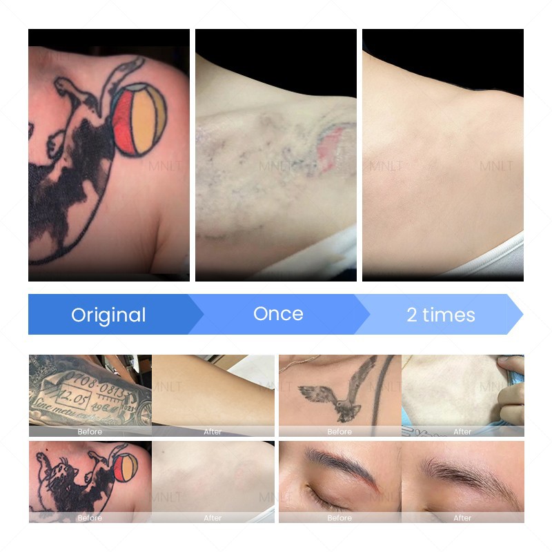 Portable Nd:YAG Laser Machine For Tattoo Removal & Skin Rejuvenation suppliers