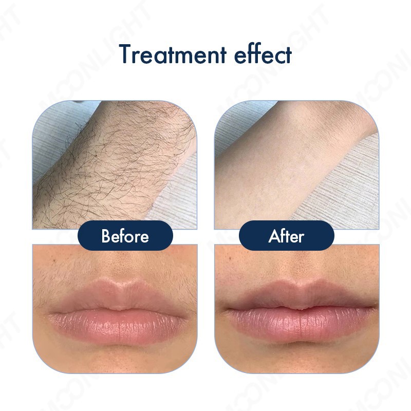 ND-YAGDiode-laser-D210