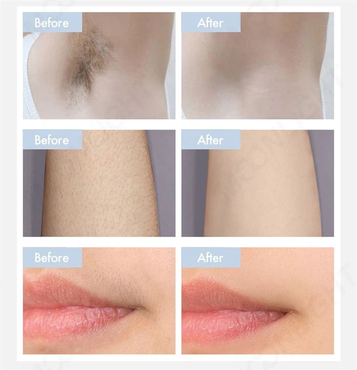 Upgrade Diode Laser Hair Removal
